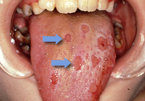 ヘルペスウイルスによる口内炎