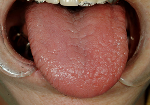 シェーグレン症候群